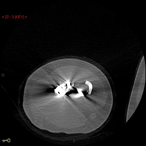 Figure 2 for case Re-fracture distal humerus